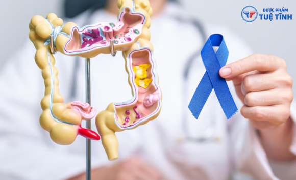 Ung thư đại tràng: Nguyên nhân, dấu hiệu và cách phòng bệnh 