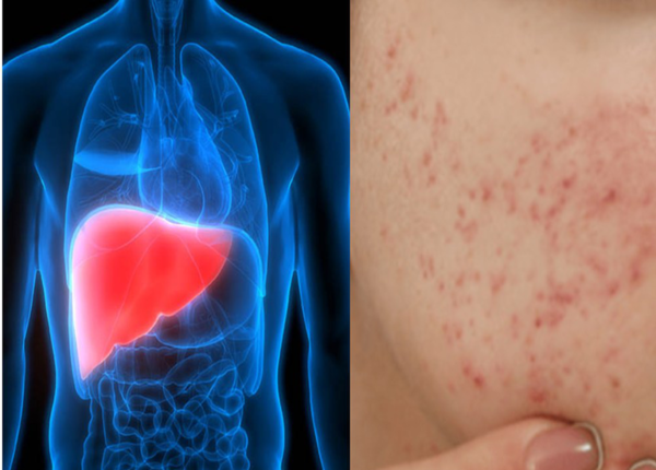 Mắc viêm gan B có gây ngứa không? Hướng cải thiện hiệu quả 