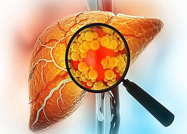 Dấu hiệu gan nhiễm mỡ mà bạn cần biết?