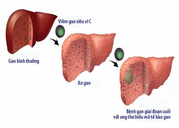 Dấu hiệu xơ gan do mắc viêm gan C và cách nhận biết?